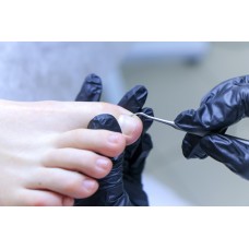 Обработка вросшего ногтя